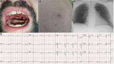 Case report: From monkeypox pharyngitis to myopericarditis and atypical skin lesions